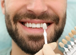Veneers