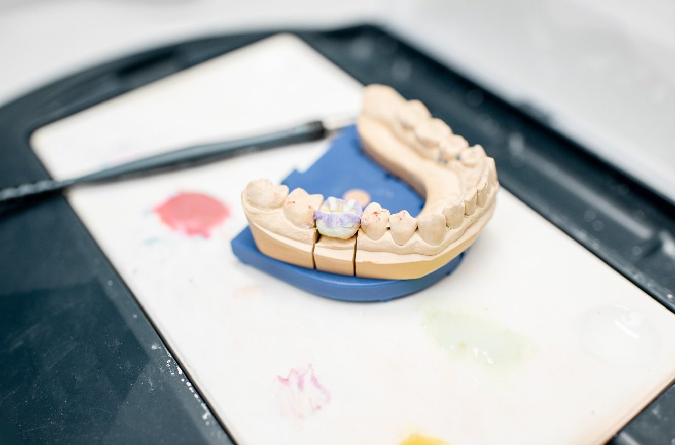 Affordable Dental Crowns in Al Ain Treatment Options and Benefits
