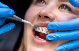 Dental Braces in Al Ain: How to Choose the Right Orthodontist for Your Braces Treatment